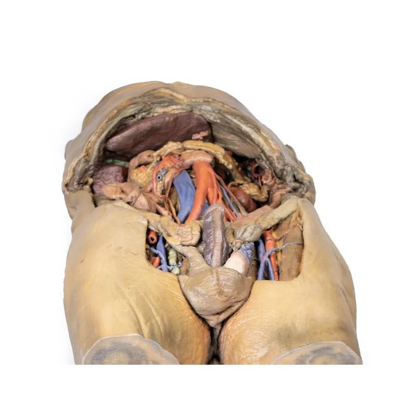 3D Printed Abdomen with Bilateral Hernias