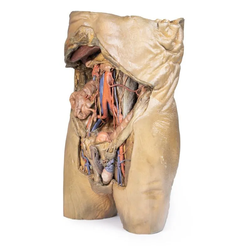 3D Printed Abdomen with Bilateral Hernias