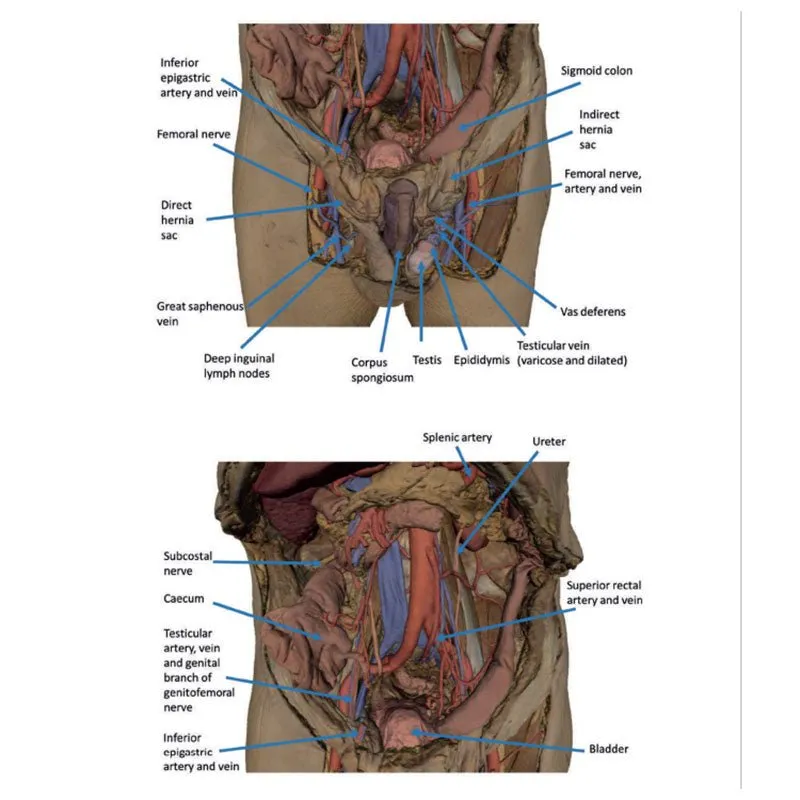 3D Printed Abdomen with Bilateral Hernias