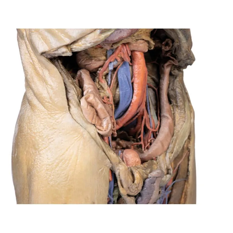 3D Printed Abdomen with Bilateral Hernias