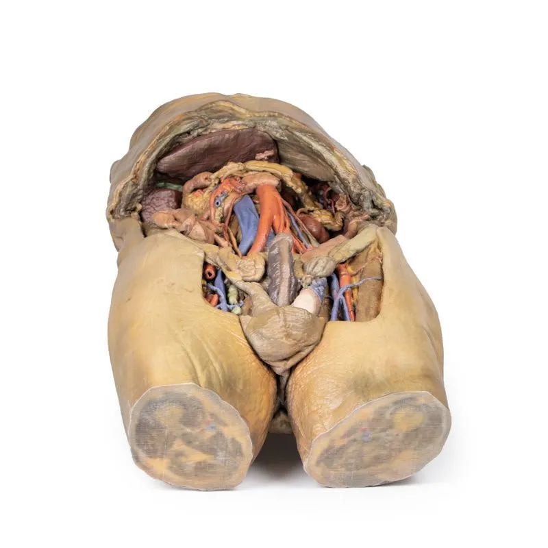 3D Printed Abdomen with Bilateral Hernias