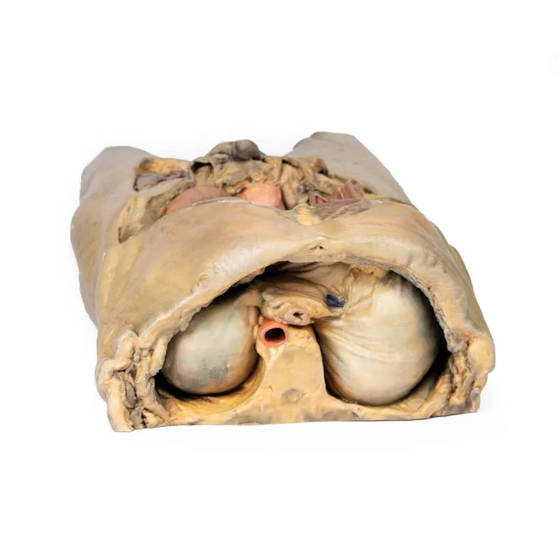 3D Printed Abdomen with Bilateral Hernias