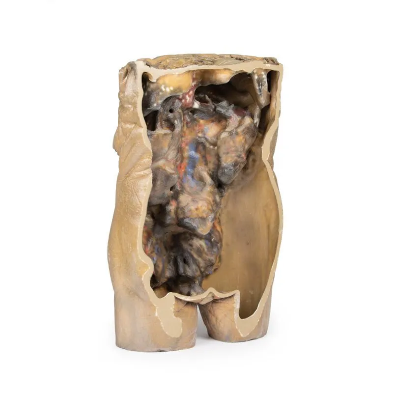 3D Printed Abdomen with Bilateral Hernias