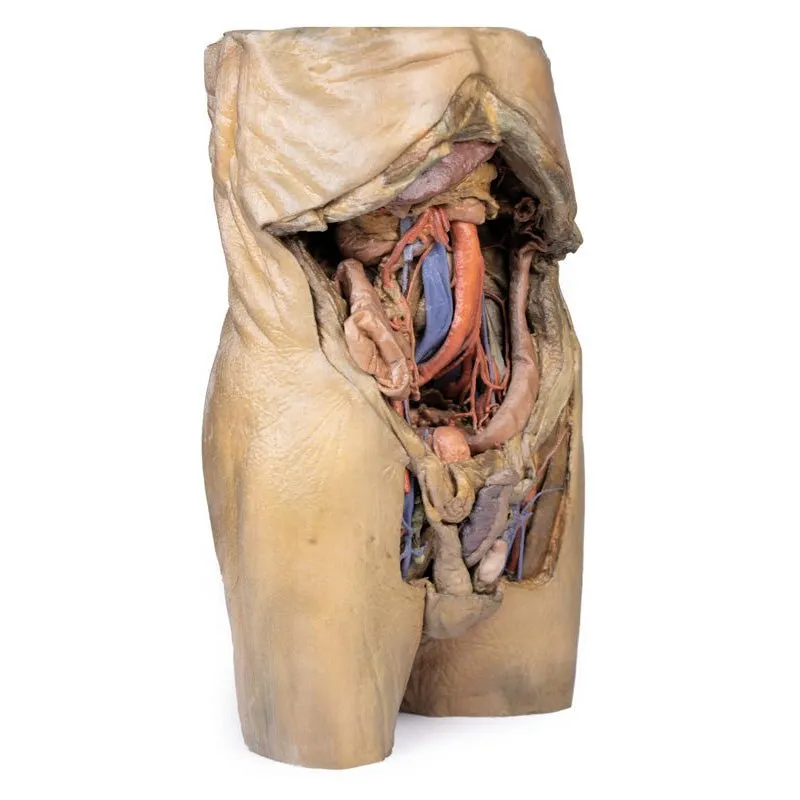 3D Printed Abdomen with Bilateral Hernias